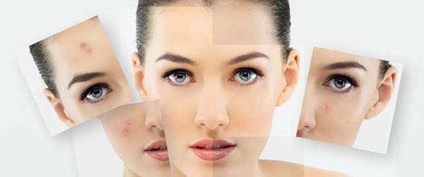 лечения акне 3